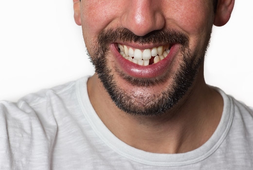 Dental Implants Vancouver, BC Dental Implants Vancouver, BC