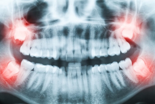 Wisdom Tooth Removal in Vancouver, BC Wisdom Tooth Removal in Vancouver, BC